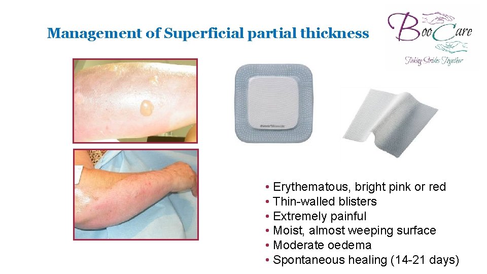 Management of Superficial partial thickness • Erythematous, bright pink or red • Thin-walled blisters