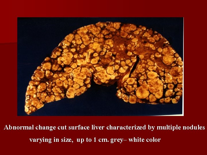 Abnormal change cut surface liver characterized by multiple nodules , varying in size, up