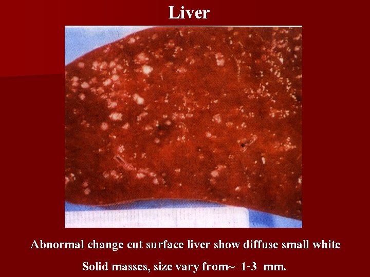 Liver Abnormal change cut surface liver show diffuse small white Solid masses, size vary