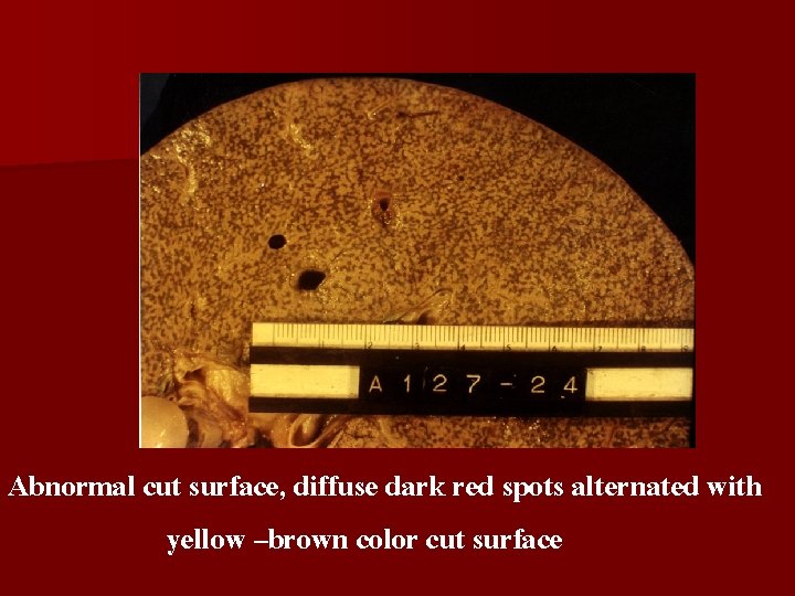 Abnormal cut surface, diffuse dark red spots alternated with yellow –brown color cut surface