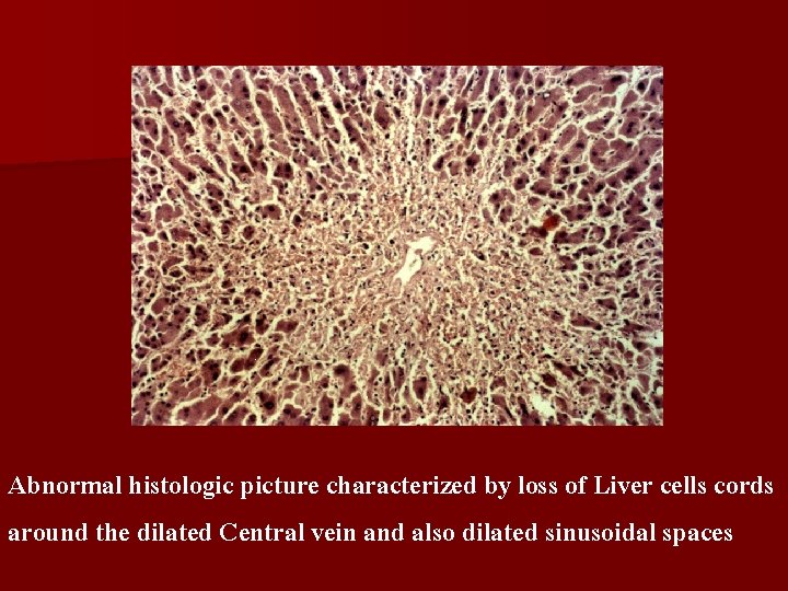 Abnormal histologic picture characterized by loss of Liver cells cords around the dilated Central