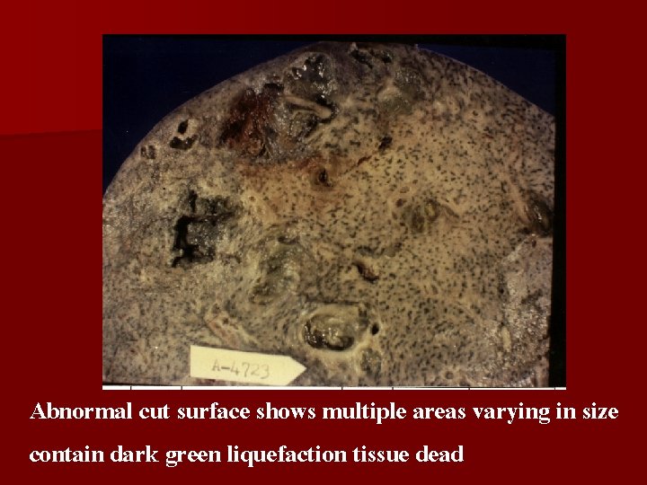 Abnormal cut surface shows multiple areas varying in size contain dark green liquefaction tissue