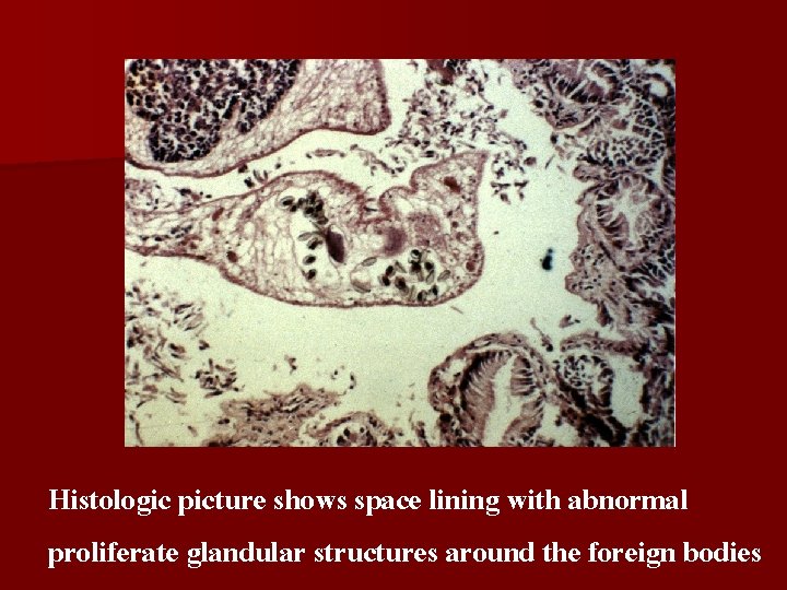 Histologic picture shows space lining with abnormal proliferate glandular structures around the foreign bodies