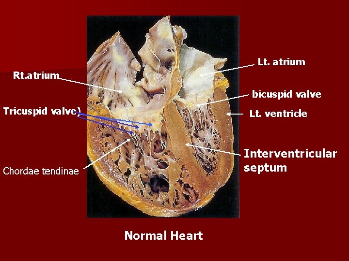Lt. atrium Rt. atrium bicuspid valve Tricuspid valve) Lt. ventricle Interventricular septum Chordae tendinae
