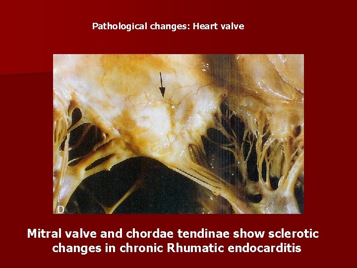 Pathological changes: Heart valve Mitral valve and chordae tendinae show sclerotic changes in chronic