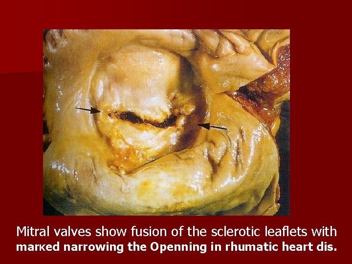 Mitral valves show fusion of the sclerotic leaflets with mar. Ked narrowing the Openning