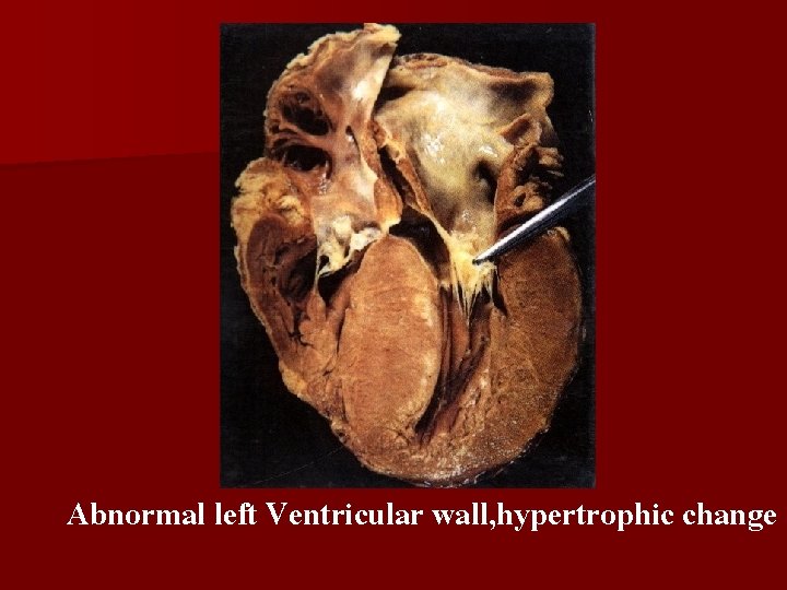 Abnormal left Ventricular wall, hypertrophic change 
