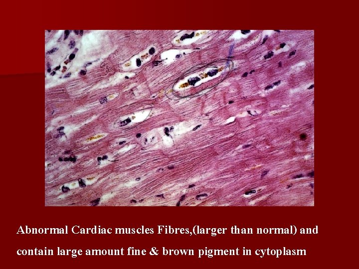 Abnormal Cardiac muscles Fibres, (larger than normal) and contain large amount fine & brown