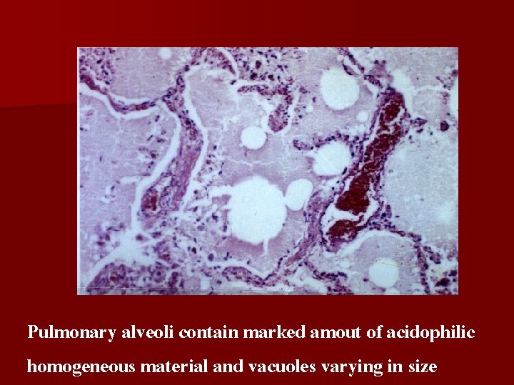 Pulmonary alveoli contain marked amout of acidophilic homogeneous material and vacuoles varying in size