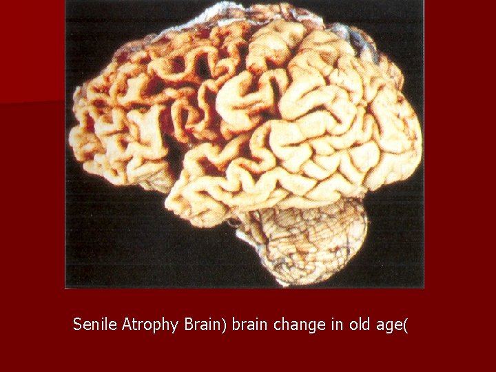 Senile Atrophy Brain) brain change in old age( 