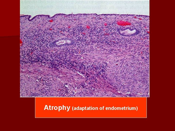 Atrophy (adaptation of endometrium) 
