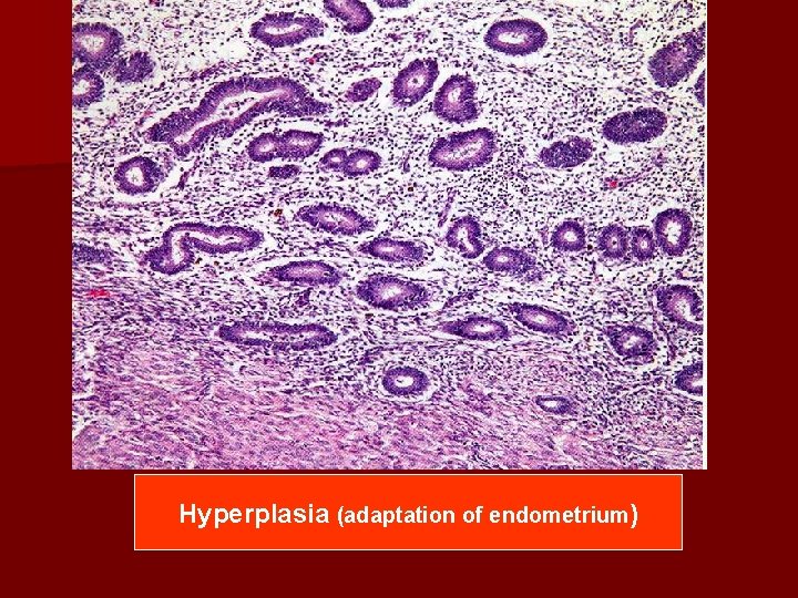 Hyperplasia (adaptation of endometrium) 