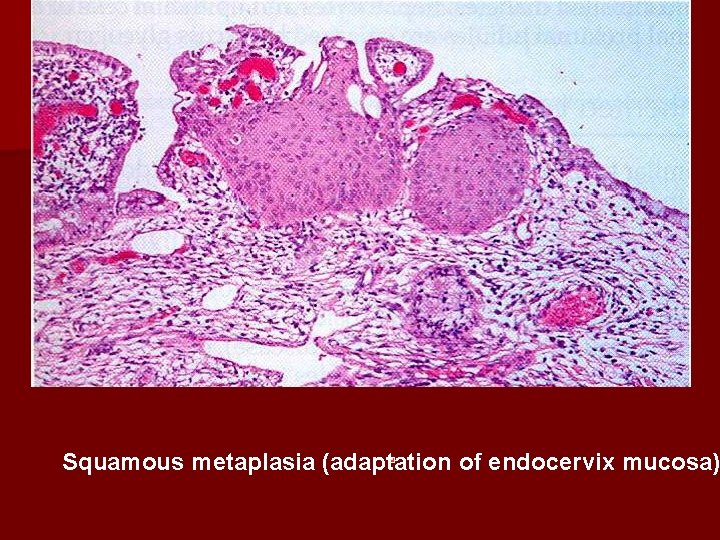 Squamous metaplasia (adaptation of endocervix mucosa) 