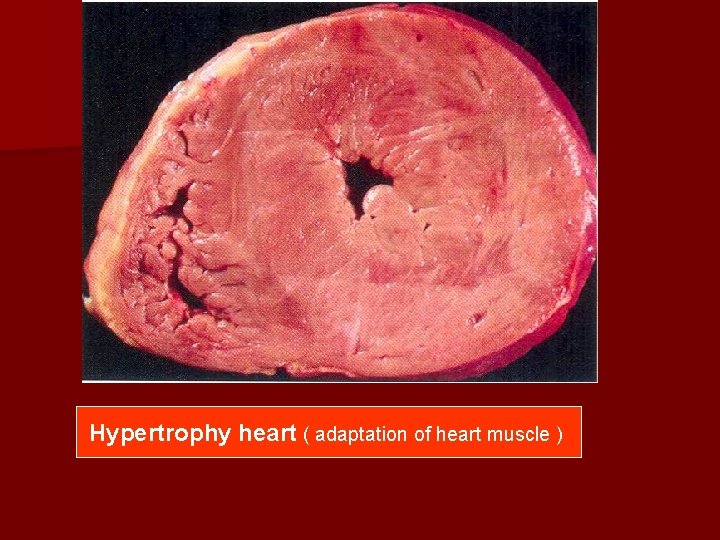 Hypertrophy heart ( adaptation of heart muscle ) 