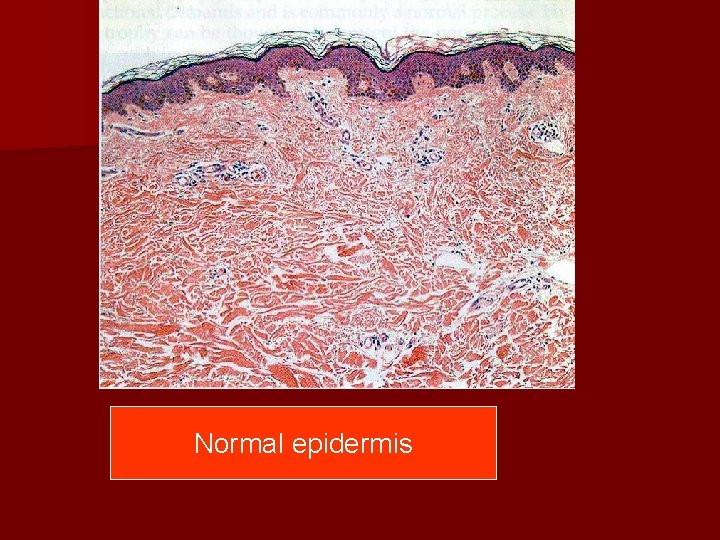 Normal epidermis 