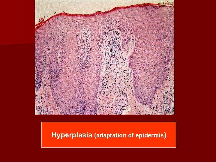 Hyperplasia (adaptation of epidermis) 