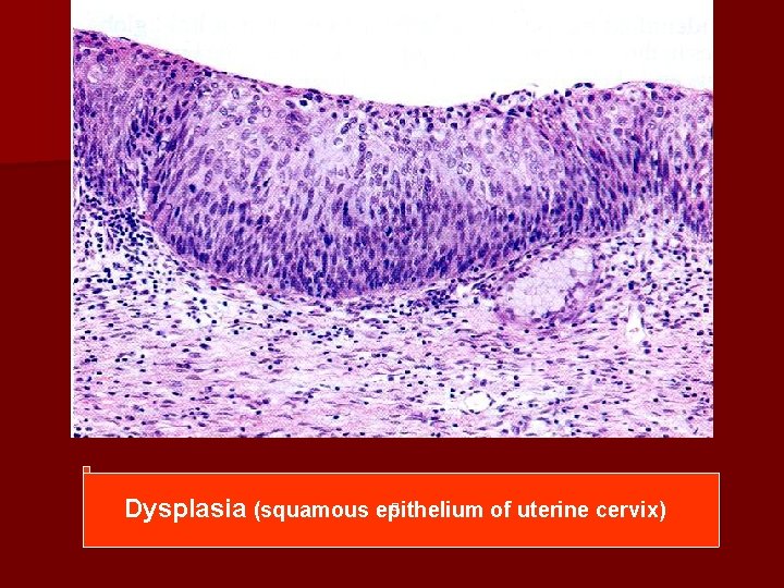 Dysplasia (squamous epithelium of uterine cervix) 