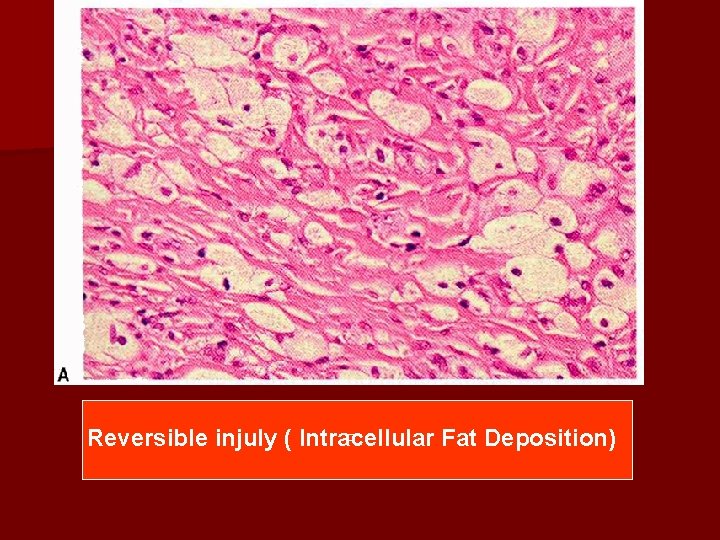 Reversible injuly ( Intracellular Fat Deposition) 