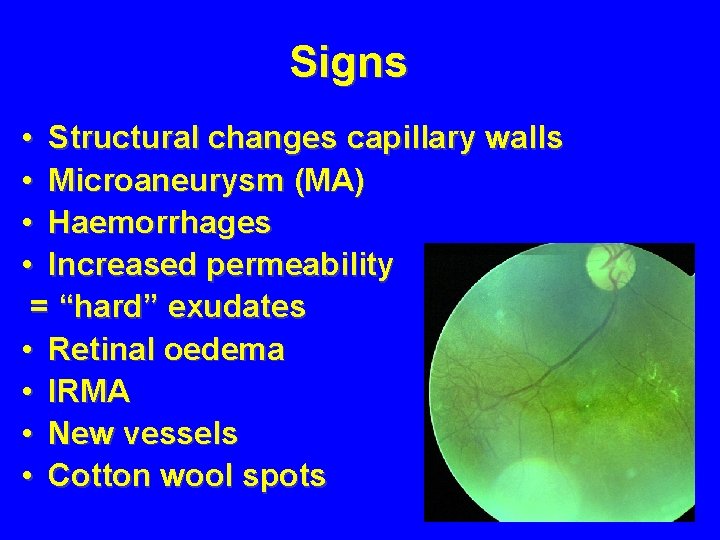 Signs • Structural changes capillary walls • Microaneurysm (MA) • Haemorrhages • Increased permeability