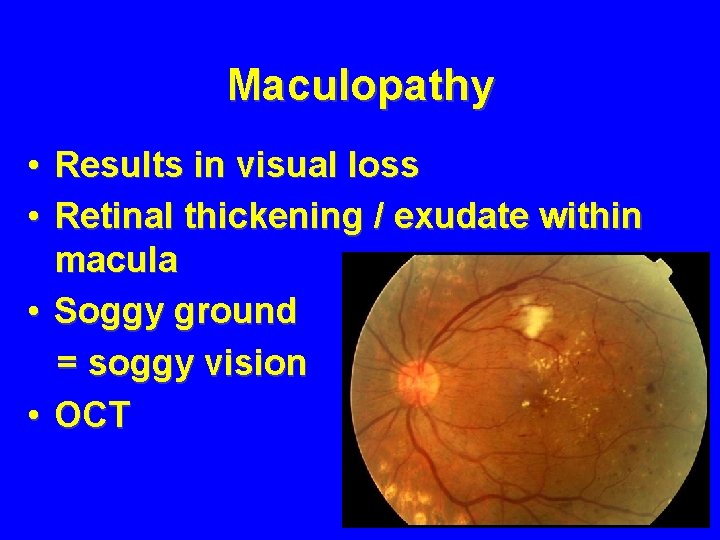 Maculopathy • Results in visual loss • Retinal thickening / exudate within macula •