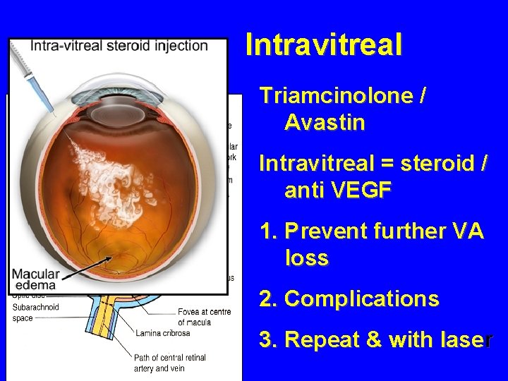 Intravitreal Triamcinolone / Avastin Intravitreal = steroid / anti VEGF 1. Prevent further VA