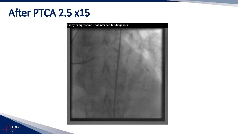 After PTCA 2. 5 x 15 TOTA L 