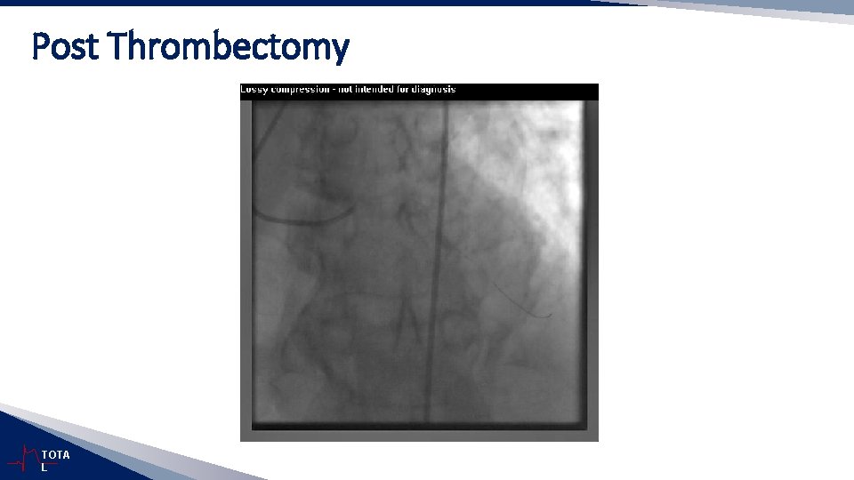 Post Thrombectomy TOTA L 