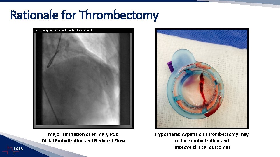 Rationale for Thrombectomy Major Limitation of Primary PCI: Distal Embolization and Reduced Flow TOTA