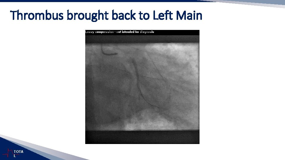 Thrombus brought back to Left Main TOTA L 