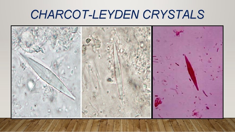 CHARCOT-LEYDEN CRYSTALS 