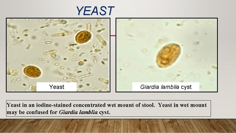 YEAST Yeast Giardia lamblia cyst Yeast in an iodine-stained concentrated wet mount of stool.