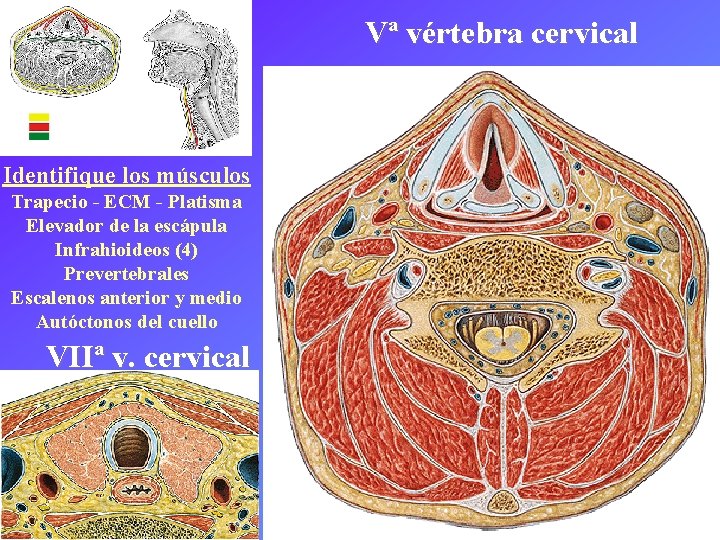 Vª vértebra cervical Identifique los músculos Trapecio - ECM - Platisma Elevador de la