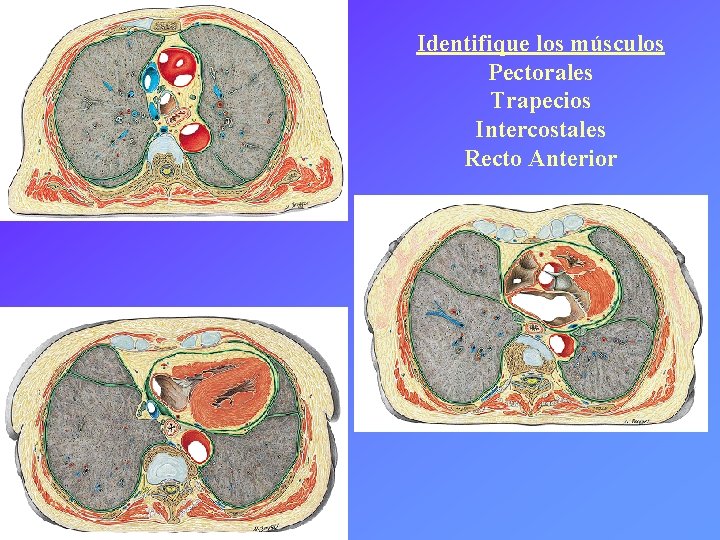 Identifique los músculos Pectorales Trapecios Intercostales Recto Anterior 