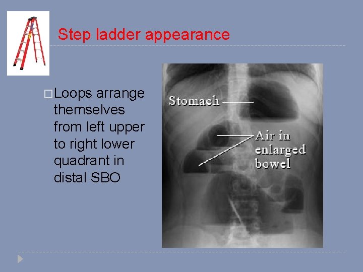 Step ladder appearance �Loops arrange themselves from left upper to right lower quadrant in