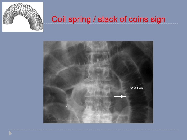 Coil spring / stack of coins sign 