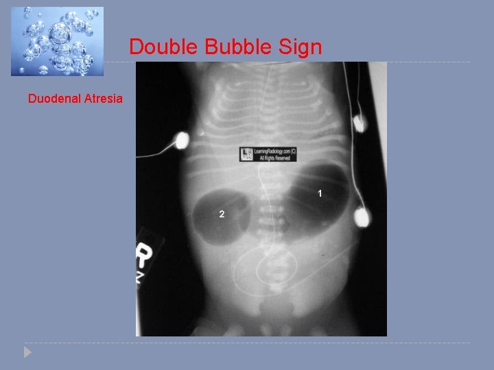 Double Bubble Sign Duodenal Atresia 