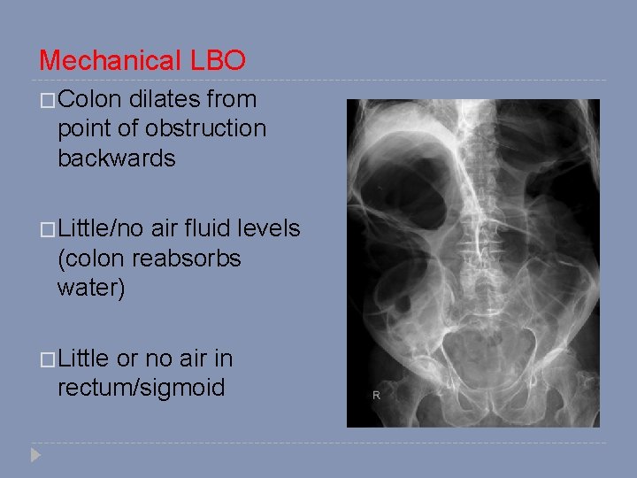 Mechanical LBO �Colon dilates from point of obstruction backwards �Little/no air fluid levels (colon