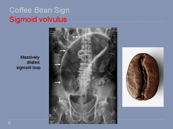 Coffee Bean Sigmoid volvulus Massively dilated sigmoid loop 