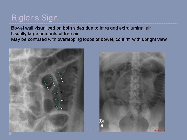 Rigler’s Sign Bowel wall visualised on both sides due to intra and extraluminal air