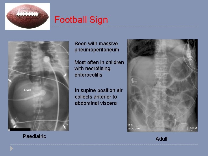 Football Sign Seen with massive pneumoperitoneum Most often in children with necrotising enterocolitis In