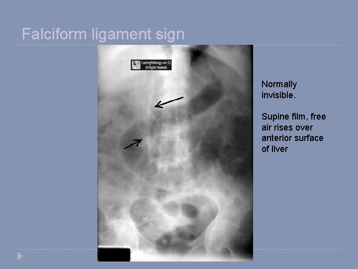 Falciform ligament sign Normally invisible. Supine film, free air rises over anterior surface of