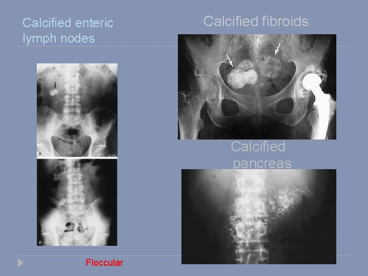 Calcified enteric lymph nodes Calcified fibroids Calcified pancreas Floccular 