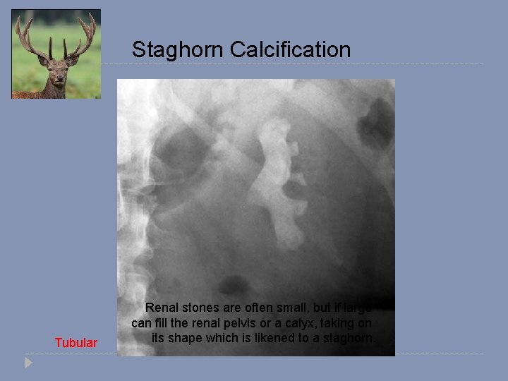 Staghorn Calcification Tubular Renal stones are often small, but if large can fill the