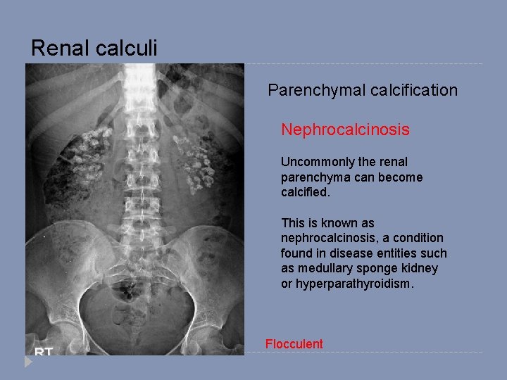 Renal calculi Parenchymal calcification Nephrocalcinosis Uncommonly the renal parenchyma can become calcified. This is
