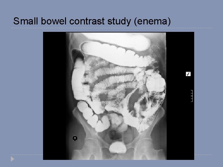 Small bowel contrast study (enema) 