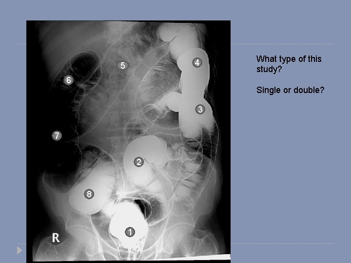 4 5 What type of this study? 6 Single or double? 3 7 2