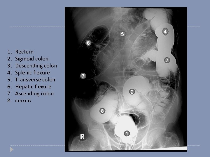 4 5 6 1. 2. 3. 4. 5. 6. 7. 8. Rectum Sigmoid colon