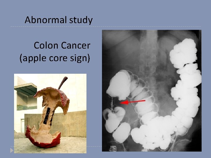 Abnormal study Colon Cancer (apple core sign) 