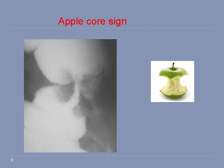 Apple core sign 