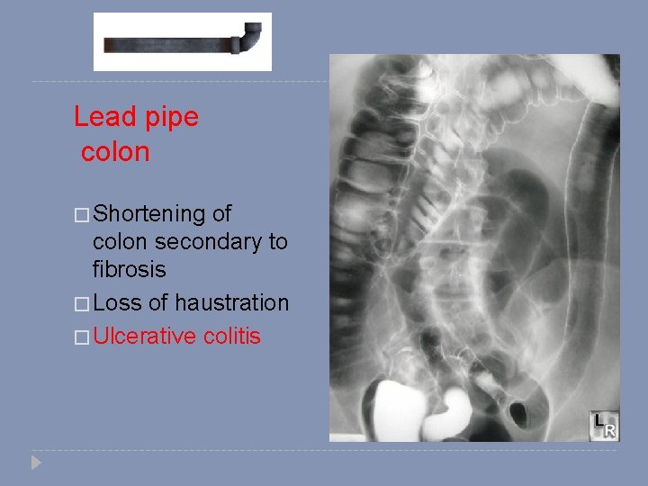 Lead pipe colon � Shortening of colon secondary to fibrosis � Loss of haustration